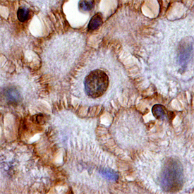 14-3-3? antibody in Human Squamous Cell Carcinoma by Immunohistochemistry (IHC-P).