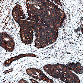 4-Hydroxynonenal antibody in Human Prostate Cancer Tissue by Immunohistochemistry (IHC-P).