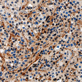 Fibronectin antibody in Human Breast Cancer Tissue by Immunohistochemistry (IHC-P).