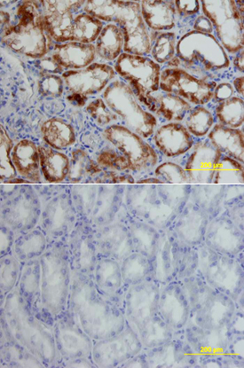 HIF-1 alpha/HIF1A antibody in Human Kidney Cancer Tissue by Immunohistochemistry (IHC-P).