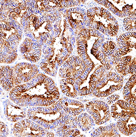 HSP27 antibody in Human Ovarian Cancer Tissue by Immunohistochemistry (IHC-P).